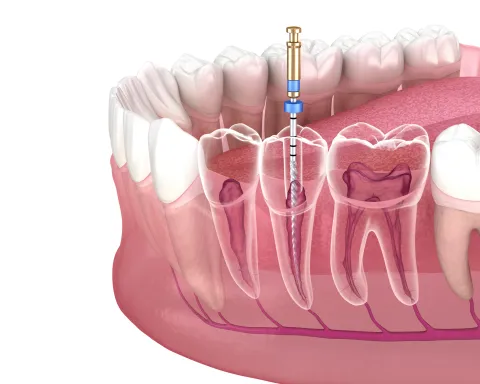 endodontie avenue Molière